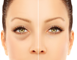 Тъмни кръгове под очите - причини, прикриване и лечение