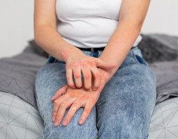 Psoriasis: causes, symptoms, treatment, folk recipes and health products